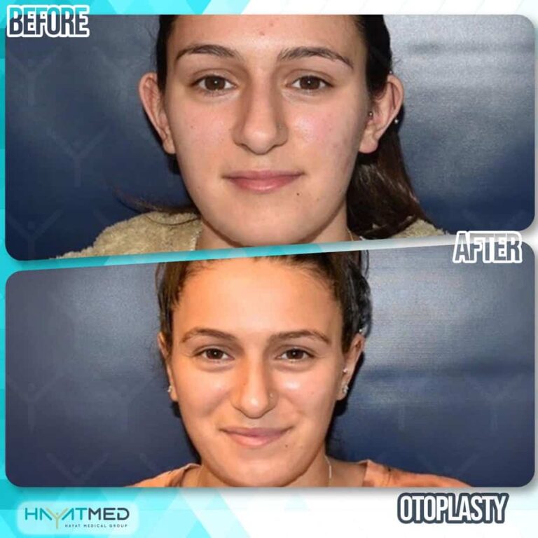 otoplasty before and after 1