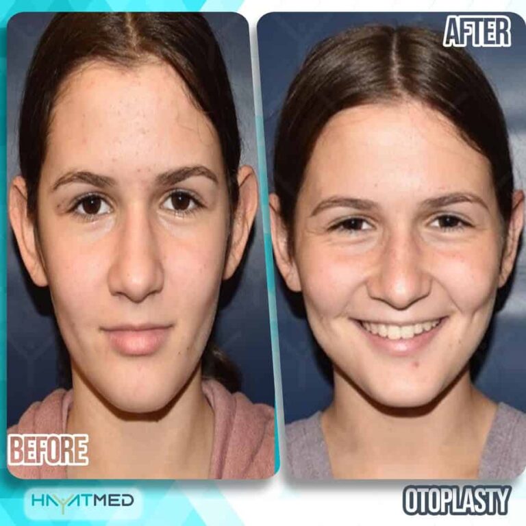 otoplasty before and after 2