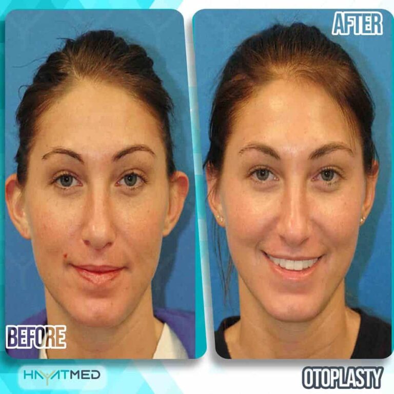 otoplasty before and after 3
