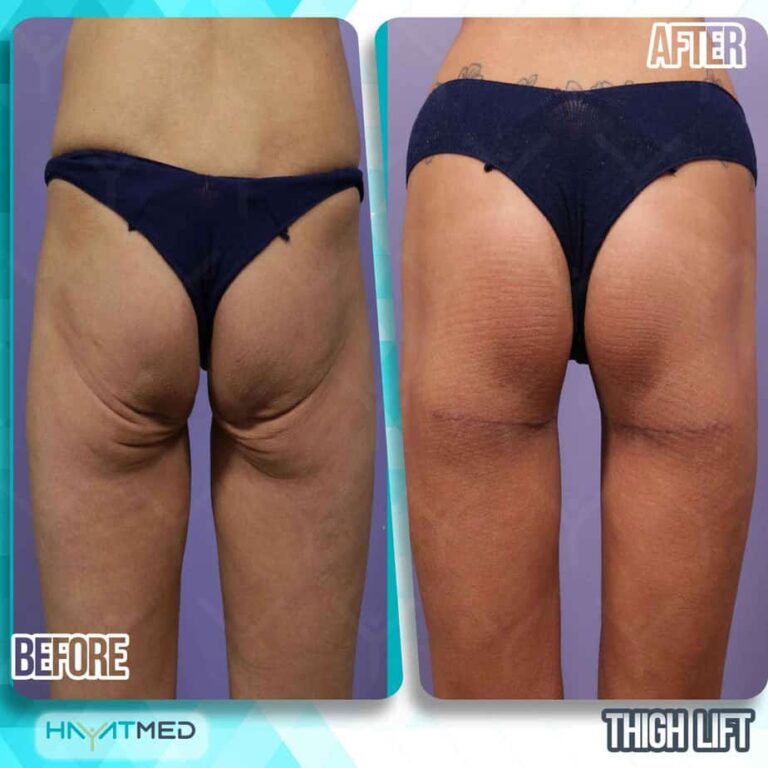 thigh lift before and after 2