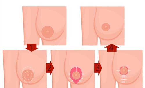 Breast Reduction Recovery guide