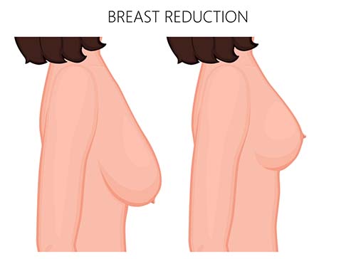 What is the breast reduction surgery procedure