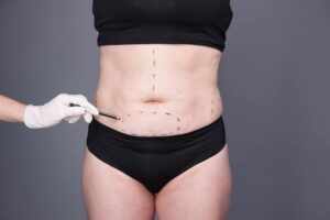 What is the cost of a tummy tuck