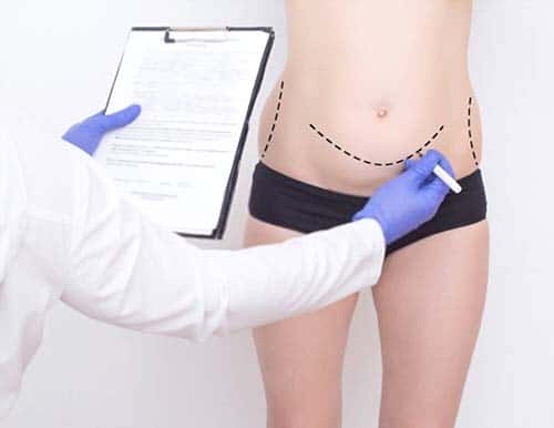 Abdominoplasty scars
