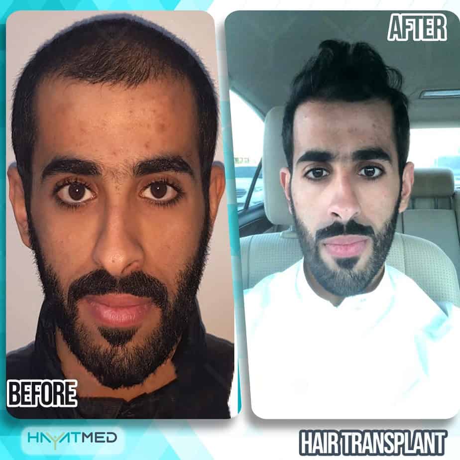 DHI Hair Transplant In Turkey: 6 Thing You Should Know & Price