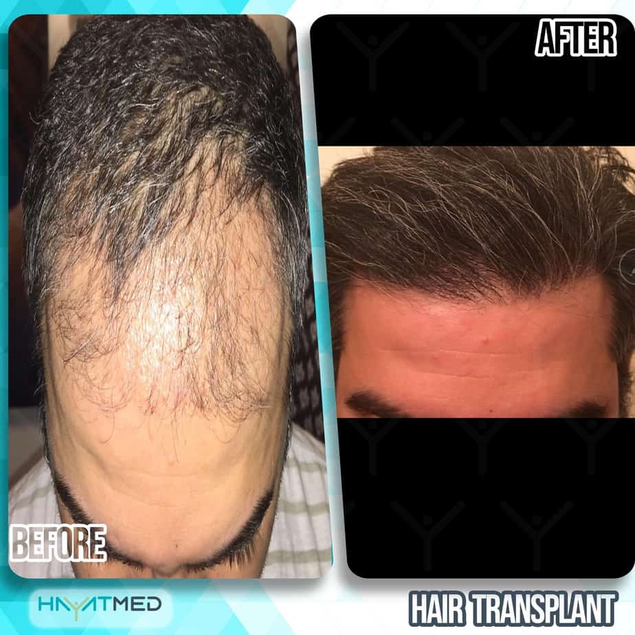 Best Hair Transplant In Turkey: Latest Techniques & Price