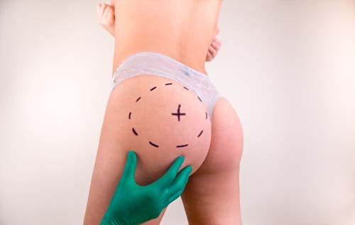 The Quantity of Fat needed for Buttock Augmentation