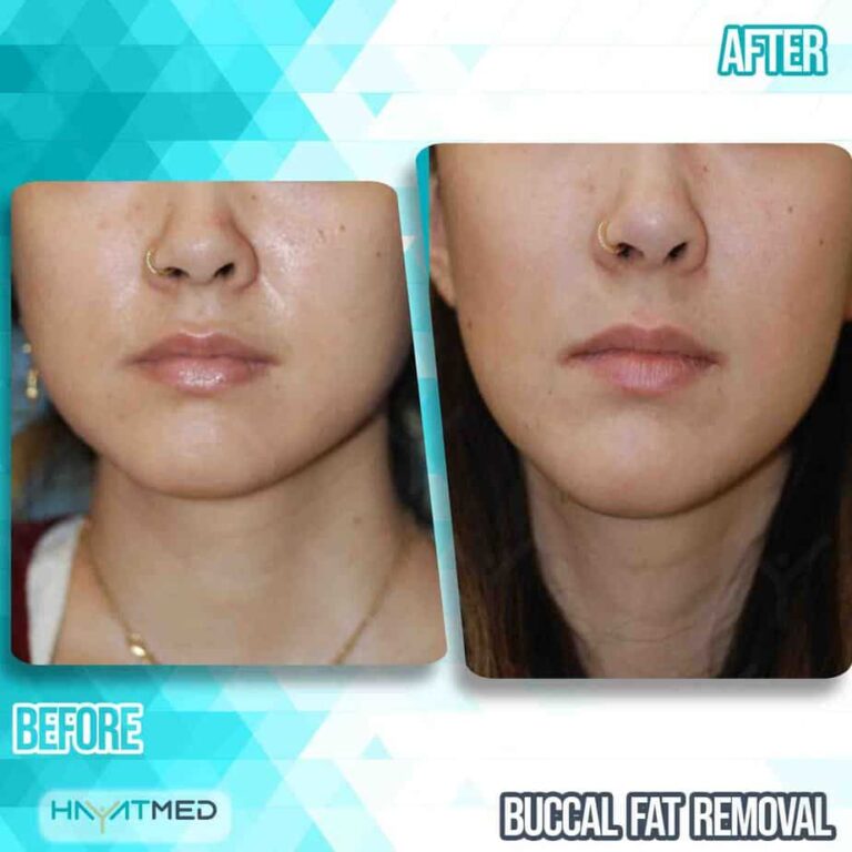 Buccal fat removal 5