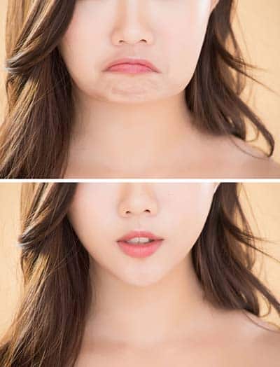 Does Insurance Cover Cheek Reduction Surgery?