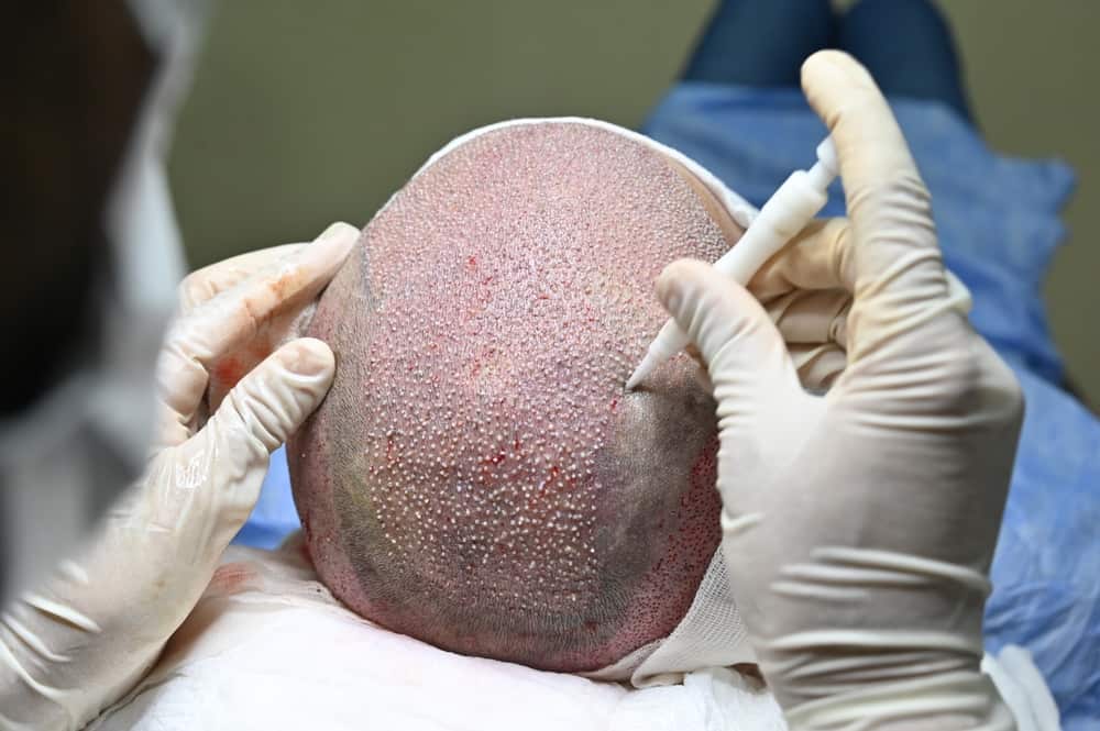 All You Need to Know About DHI Hair Transplant