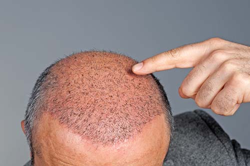 after DHI hair transplant