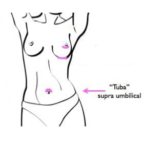 Trans Umbilical Breast Augmentation (TUBA)
