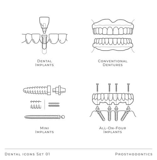 All-on-4 vs. dentures