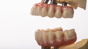 Cost of All-on-4 Dental Implants