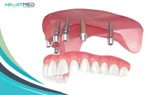 Cost of All-on-4 Dental Implants new