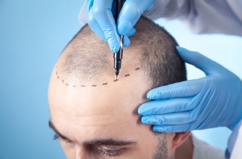 Hair Transplant Overview
