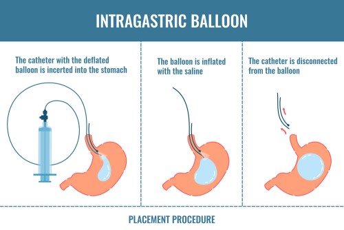 What is a gastric balloon