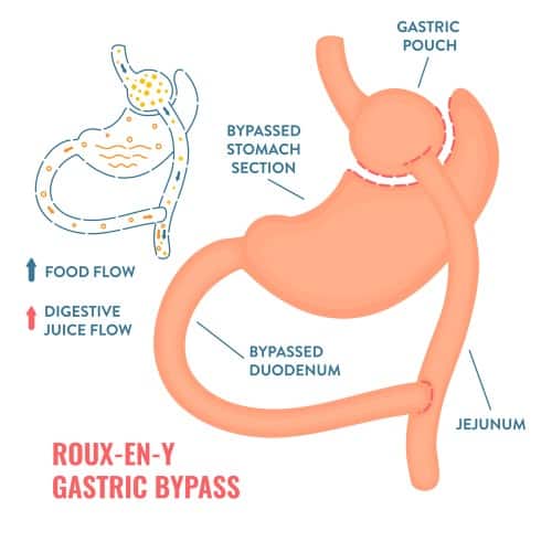 Advantages And Disadvantages Of Gastric Bypass Surgery