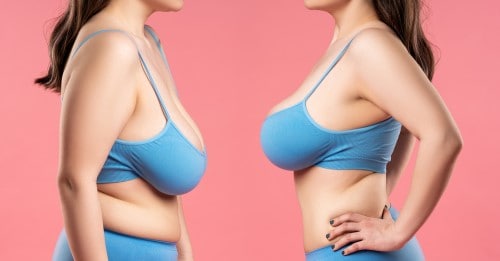 Why do women get breast reductions