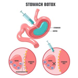stomach Botox complications