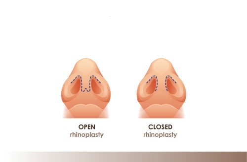 Closed rhinoplasty