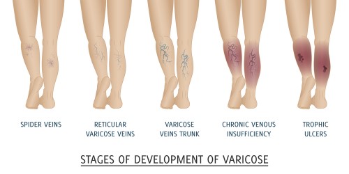 Surgery for varicose veins