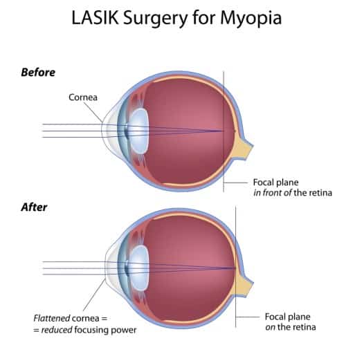 What happens after LASIK eye surgery