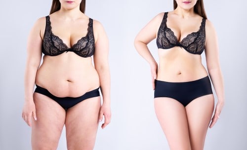 What's the Difference Between Liposuction and a Tummy Tuck