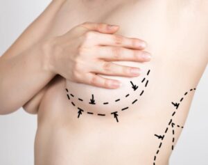 breast augmentation for mommy makeover