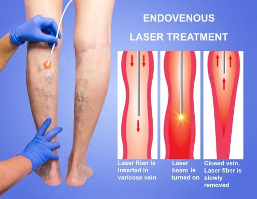 How is laser spider vein removal done