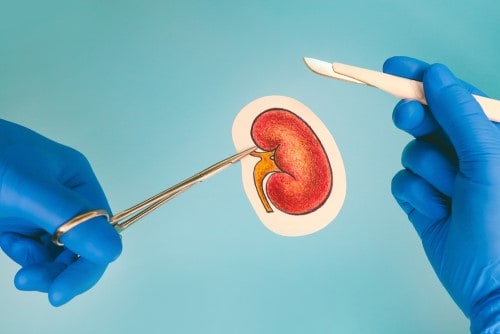The surgical procedure of a kidney transplant