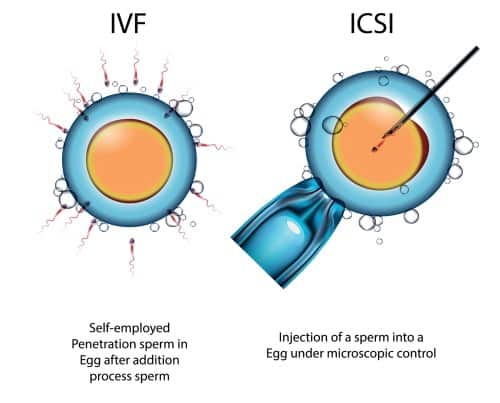 What is the difference between IVF and ICSI