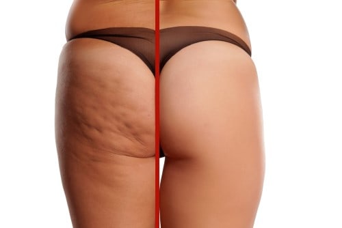 Who are the suitable candidates for cellulite treatment