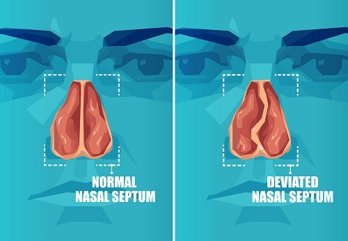 Causes of a Deviated Septum