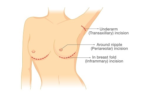 Scars after breast lift and breast implants