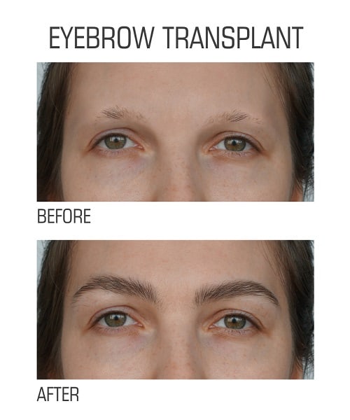 What Are Eyebrow Transplants