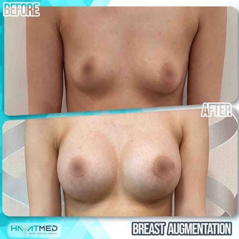 Breast augmentation 312