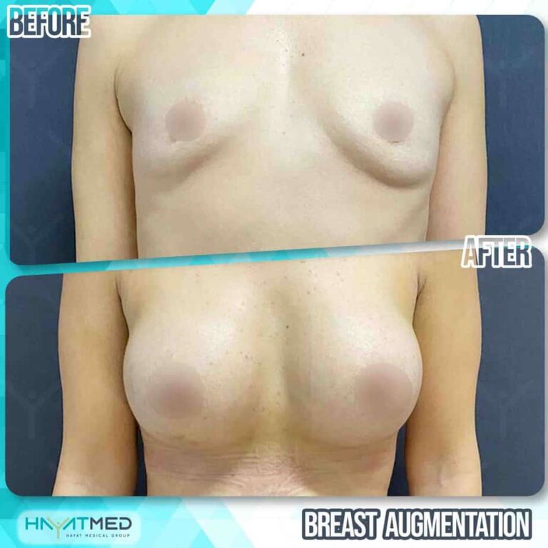 Breast augmentation 313