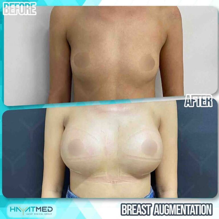 Breast augmentation 315