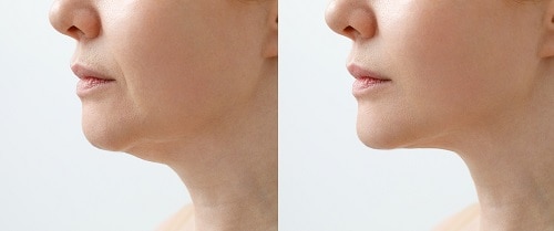 What Is a Neck Liposuction Surgery