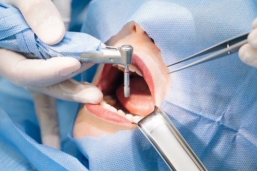 Procedure for dental implant