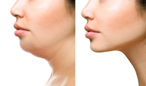 What are the benefits of neck liposuction