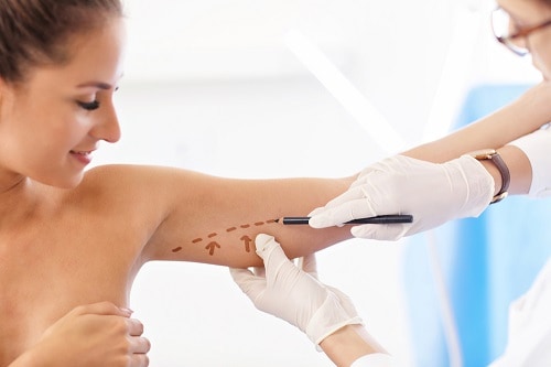 arm liposuction procedure steps