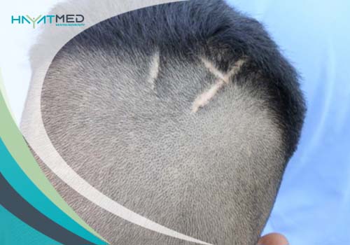 Scarring Hair Transplant Side Effects