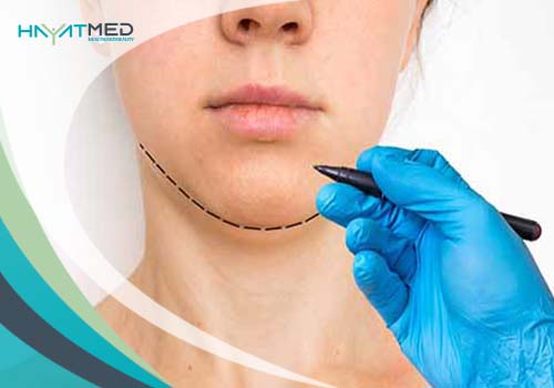 What-are-the-Advantages-of-Bichectomy new 2024