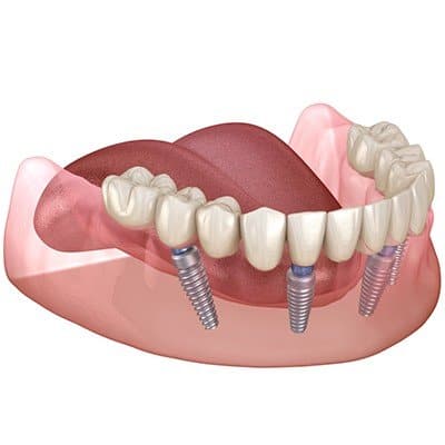 Alternative Treatments to All on 4 Dental Implants