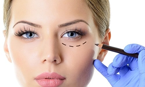 Eye surgery to remove bags under eyes