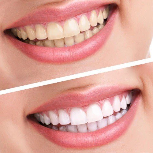 Facts about teeth whitening