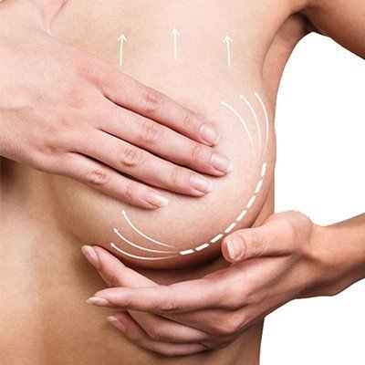 Breast Lift Surgery Result 