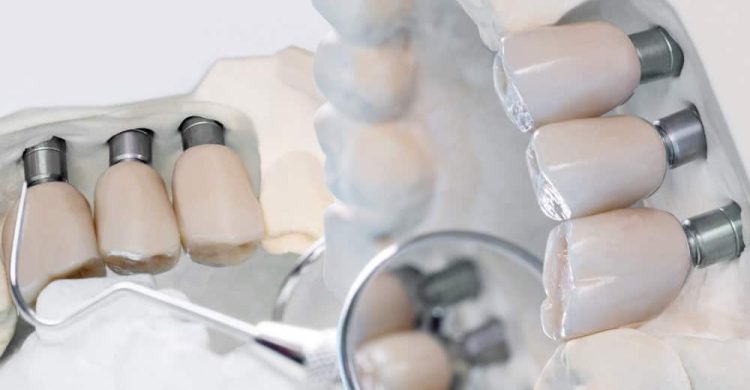 Dental Implants In Turkey 121